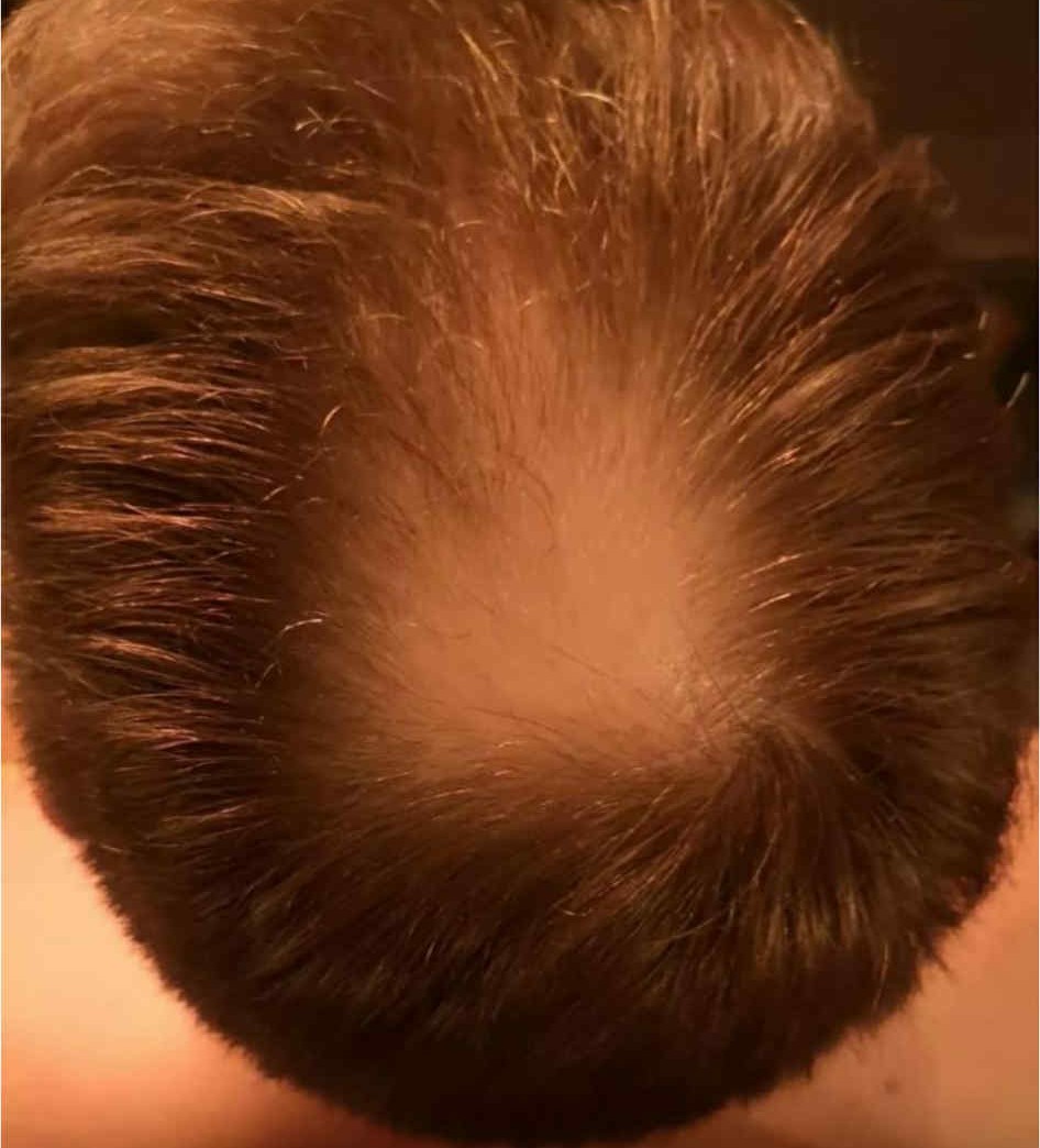 Fyrir: hvirfilsvæði með þynningu